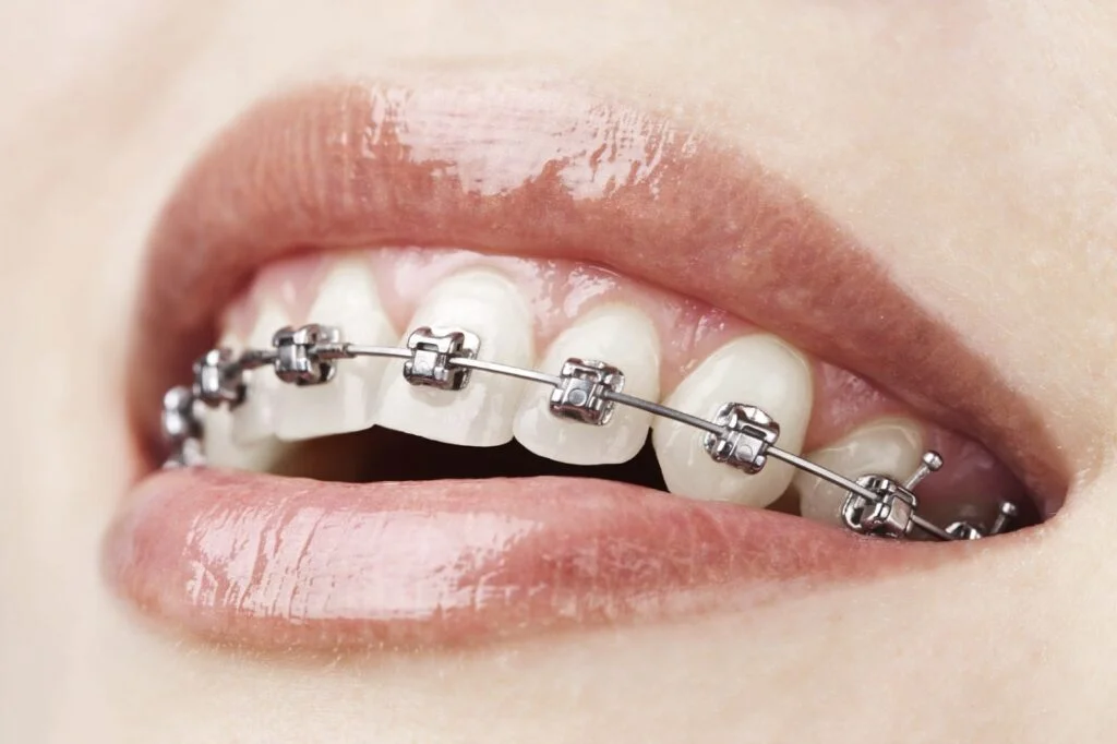 ortodoncia en sevilla Sonrisa con brackets