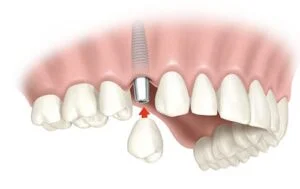 los-implantes-dentales