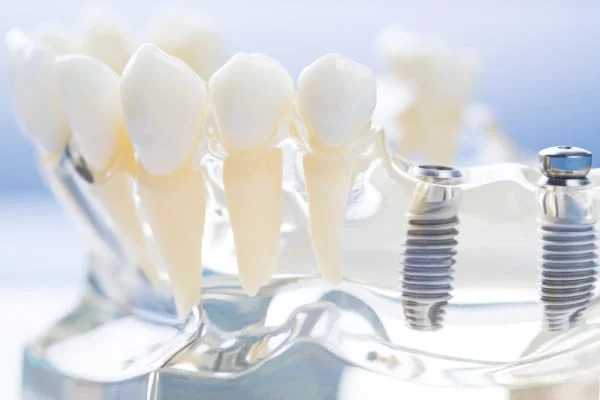 Beneficios para la salud de los implantes dentales