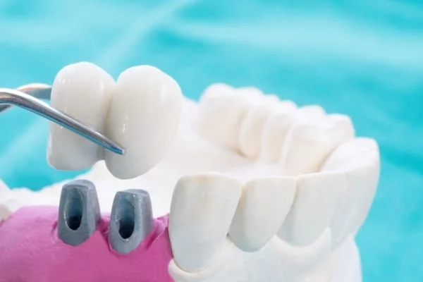 ¿Qué son los puentes dentales y cómo funcionan?