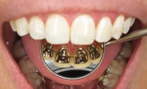 ¿Qué es la ortodoncia lingual y cuáles son sus ventajas?