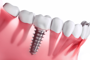 precio implante dental sevilla