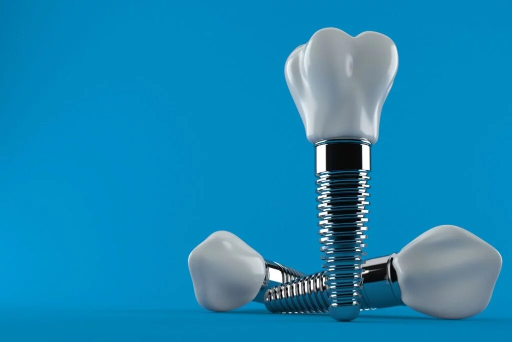Precio implante dental Sevilla