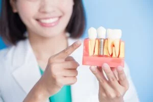 Implante dental Sevilla