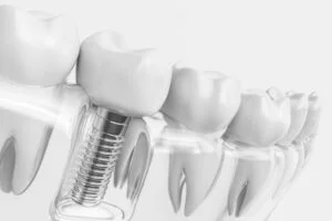 Implante dental profesional en Sevilla_ Helident