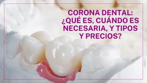 Tipos de Coronas Dentales