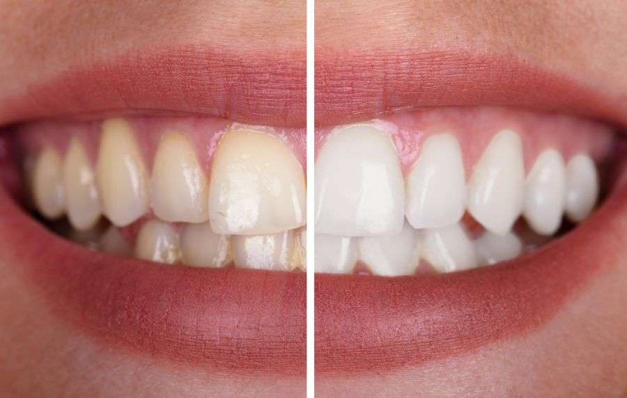 laser blanco dientes