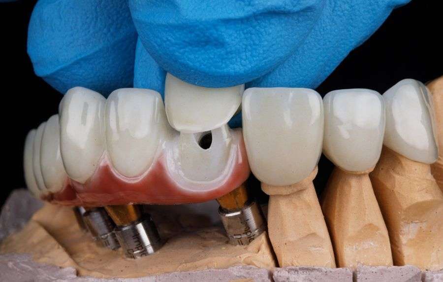 carilla dentales ortodoncia
