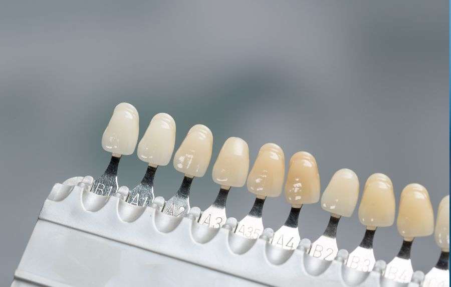 carillas dentales sevilla