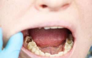 Qué es y cuál es el precio de una endodoncia