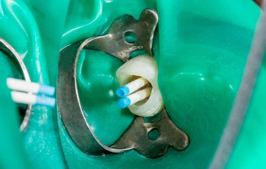 precio de una endodoncia