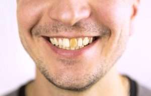 Cómo evitar el desgaste del esmalte dental
