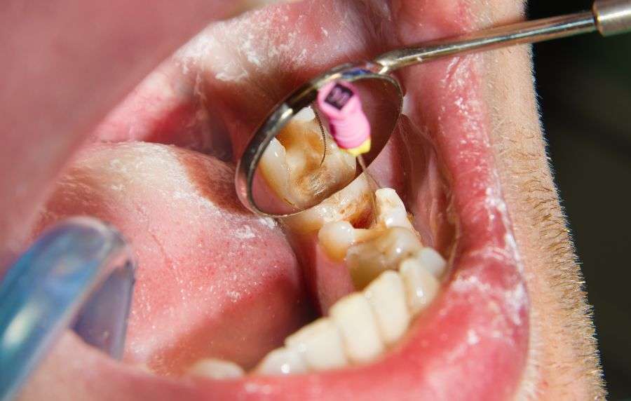 confía en helident para una endodoncia de alta calidad