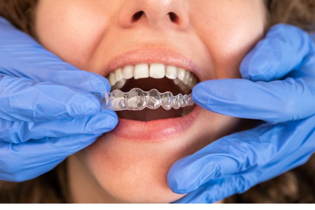 Qué es refinamiento en Invisalign y cuánto dura