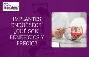 implantes dentales endooseos